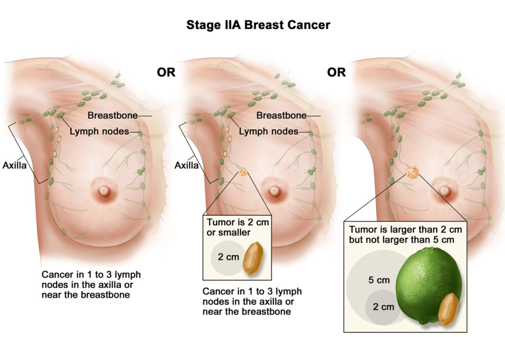 breast cancer treatment in dubai