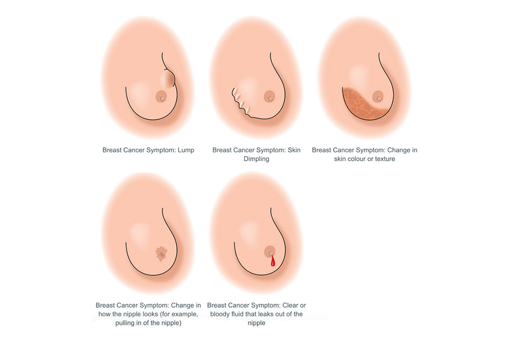 Breast Cancer Symptoms Dubai