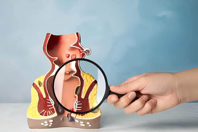 anal fistula treatment in dubai