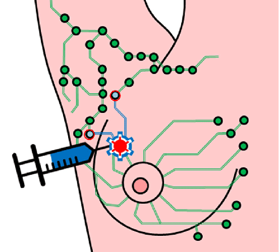 lymph node localization treatment in dubai