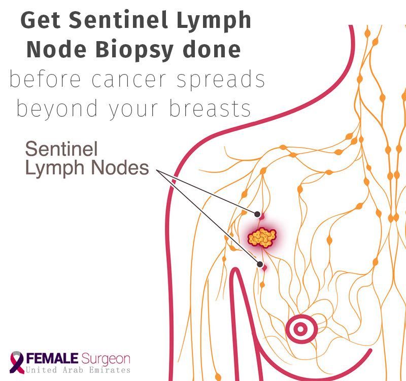 breast cancer surgery and treatment