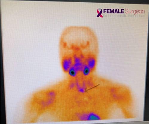 Parathyroid localization surgery in Al Zahra Thyroid Center. 6 Minimal invasive parathyroidectomy