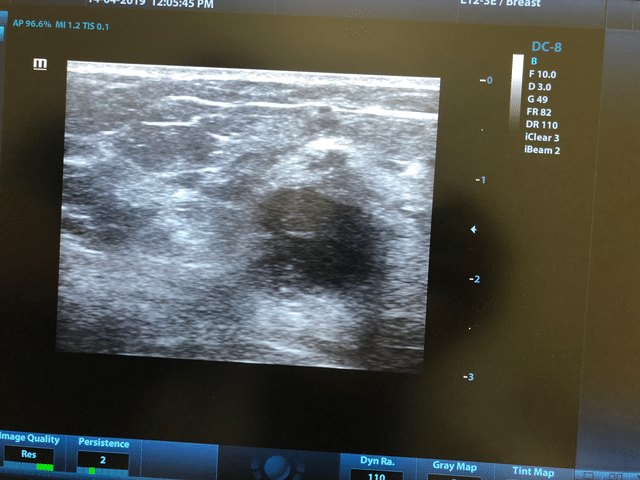Breast Ultrasound bedside in Alzahra
