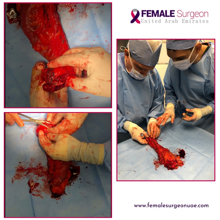breast surgery dubai