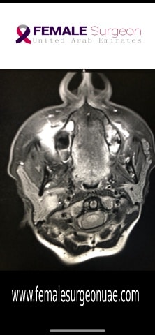 Parotid Tumor detected by Dr. Humaa Darr