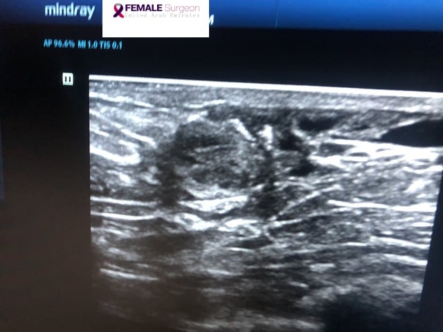Ductal Breast Papilloma