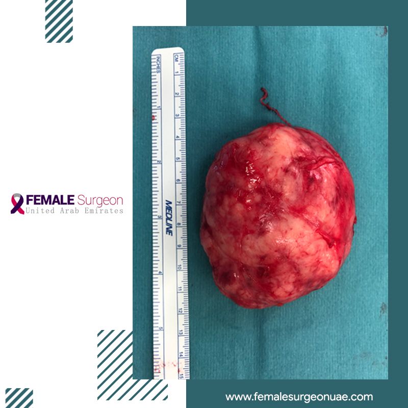 Giant juvenile fibroadenoma in a young patient with small breasts.
