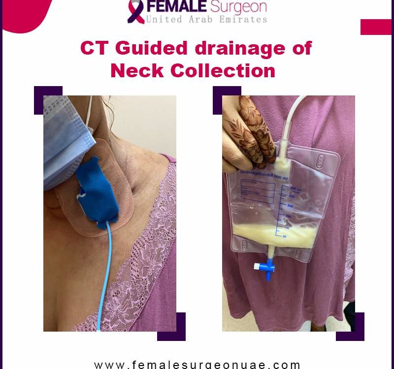 Latest News 3 CT Guided drainage of neck collection