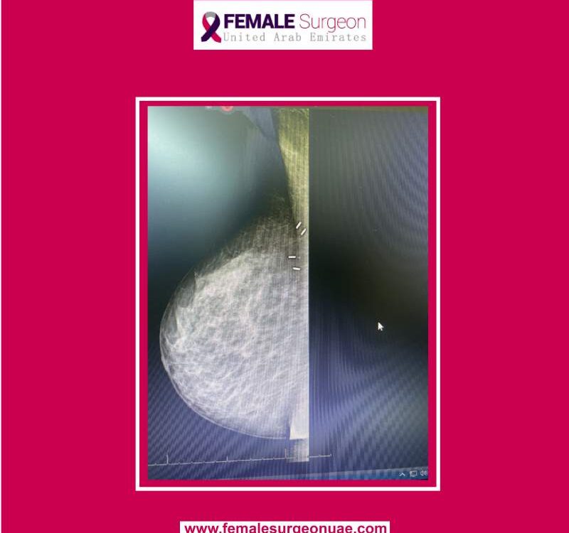 Latest News 2 Post Breast Surgery Clips.