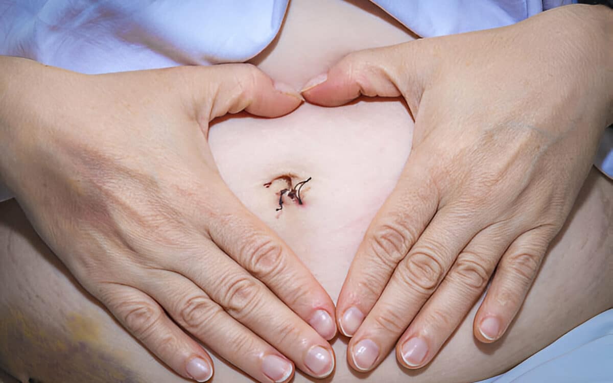 Laparoscopic Appendectomy in Dubai